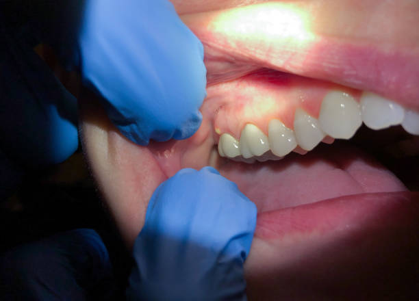 Best Emergency Dental Care for Sports Injuries in Lithia Springs, GA