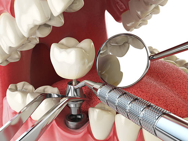 Best Knocked-Out Tooth (Avulsed Tooth) Treatment in Lithia Springs, GA